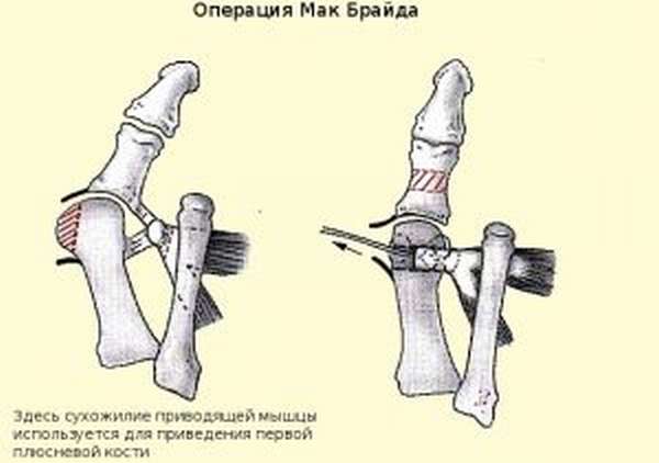 Операция по удалению косточки на ноге